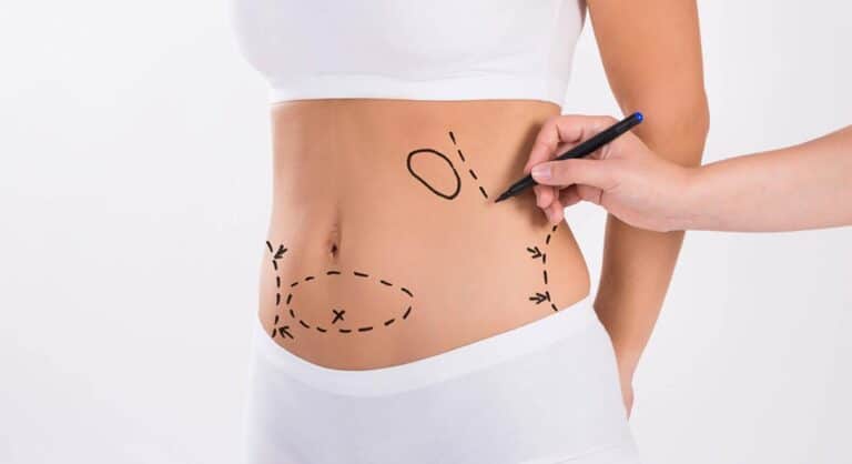 Tummy Tuck: Sculpting the Perfect Silhouette